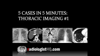 5 Cases in 5 Minutes Thoracic 1 [upl. by Alletsirhc]