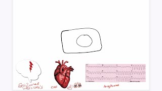 Refeeding Syndrome Explained USMLE [upl. by Rutter]