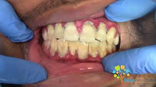 Dental Cleaning to remove heavy tartar🦷 【Young Male first cleaning】 [upl. by Thinia]