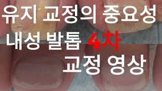 시원함주의 내성 발톱 4차 교정 영상 feat왕건이 [upl. by Sset]