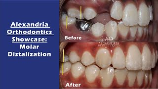 Alexandria Orthodontics Showcase Molar Distalization [upl. by Iral]