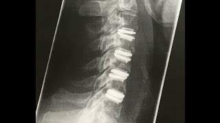 THE WEEK AFTER My 4 level cervical artificial disc replacement [upl. by Nbi]