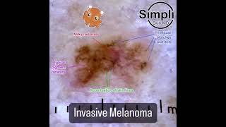 Invasive Melanoma Dermoscopy [upl. by Rozalie]