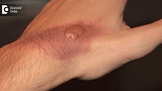 How to treat a burn blister at home Tips to avoid burn scar  Dr Pavan Murdeshwar [upl. by Engapmahc]