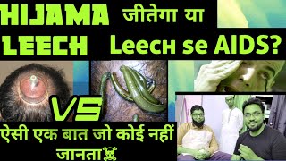 Hijama Therapy Vs Leech Therapy  कौन न है सबका बाप कौन है सबसे ज्यादा effective [upl. by Yarehs708]