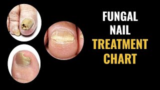 Fungal Nail Treatment Options Chart [upl. by Elram]