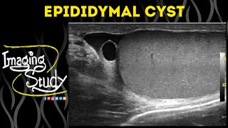 Epididymal Cyst  Ultrasound  Case 51 [upl. by Nohtan]