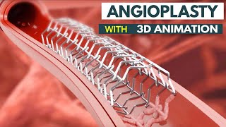 Angioplasty Procedure Explained How It Saves Lives  What Is Angioplasty StepbyStep Explanation [upl. by Lucais]