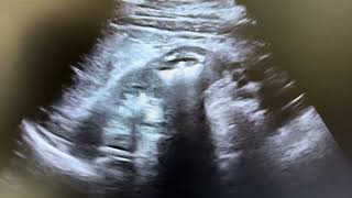 Ultrasound of nephrocalcinosis [upl. by Itagaki]