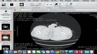 Planning surgery for acetabular fracture using HOROS [upl. by Holofernes]