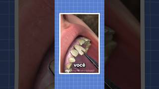 O segredo dos dentes de soldados 🦷 curiosidades fatos shorts radardascuriosidades [upl. by Arob]