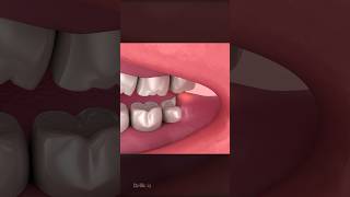 Wisdom Teeth Impaction Explained [upl. by Pincas]