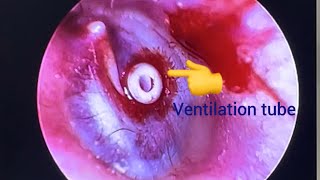 Ventilation tube insertion Part2 [upl. by Ronoel]