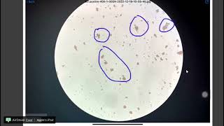 Direct coombs test positive test under microscope [upl. by Dellora]