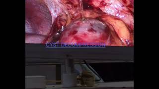 Laparoscopic Renal CYST deroofing [upl. by Berta]