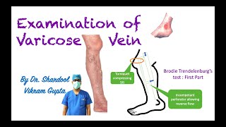 Examination of Varicose Vein for MBBS MS Surgery medical students [upl. by Grous230]