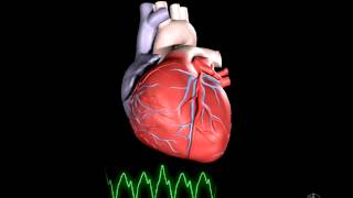 What is Ventricular Tachycardia [upl. by Asor]