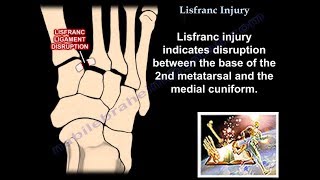 Lisfranc Injury  Everything You Need To Know  Dr Nabil Ebraheim [upl. by Oliver]