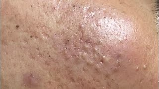 ACNE TREATMENT VU QUYNH MI Blackheads On Boy Face 2024 [upl. by Volny]