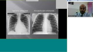 Pedicardio classes on Pulmonary stenosis Dx and Rx incl Balloon valvuloplasty by Dr Premsekar [upl. by Lashondra]