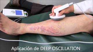 DEEP OSCILLATION sobre un Hematoma [upl. by Fayre147]