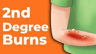 2nd Degree Burns How to Treat Them  Wound Care OC [upl. by Lemyt]