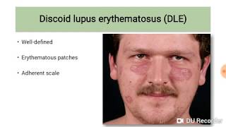 Discoid Lupus Erythematosus DLE [upl. by Toland]