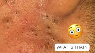 THE MOST VIEWA FACE FULL OF BLACKHEADS WHAT IS THAT 2 relaxing blackheads [upl. by Oina]