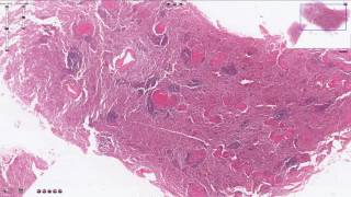 Miliary Tuberculosis  Spleen  Histopathology [upl. by Acquah]