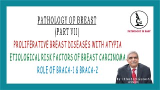 Proliferative Breast Diseases with Atypia Etiological Risk Factor of Breast CA Role BRACA1 amp BRACA2 [upl. by Belayneh]