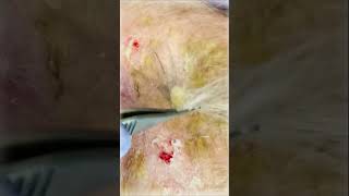 Erosive Pustulosis of the Scalp  Pimple Popping shorts [upl. by Anailil]