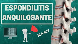 ESPONDILITIS ANQUILOSANTE ¿Qué es realmente [upl. by Yates]