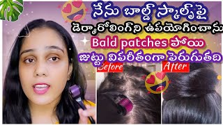 SHOCKING RESULTS 😲✨✨ ఇది Doctors hairgrowth కోసం ఉపయోగిస్తారు ✨ [upl. by Ailecara]