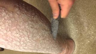 Back to scraping psoriasis part 2 [upl. by Adriano]