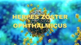 Herpes zoster ophthalmicus  OPHTHALMOLOGY  NEETPG  virus  keratitis [upl. by Undine]