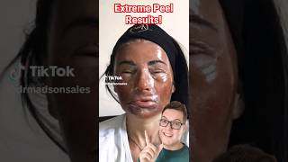 THIS IS CRAZY  Extreme Phenol Peel For Acne Scarring [upl. by Eulalee]