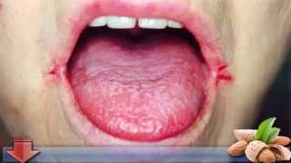 Angular Cheilitis Overnight Cure  Want An Overnight Cure For Angular Cheilitis [upl. by Balf688]