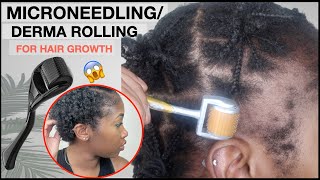 MICRONEEDLINGDERMA ROLLING FOR EDGE GROWTH  Two Month Update  TRACTION ALOPECIA 🚨 NO MINOXIDIL [upl. by Lorelle]