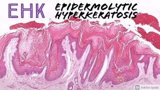 Epidermolytic Hyperkeratosis EHK 5Minute Pathology Pearls [upl. by Sana]