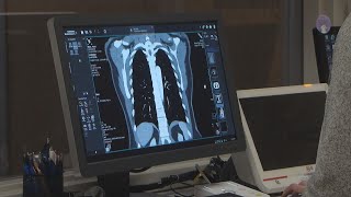 Healthbeat 4 How CNOS Imaging Center uses lowdose CT lung screenings that can detect early sign [upl. by Anthe400]