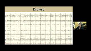 Understanding EEG A Practical Guide for Patients and Families [upl. by Washko]