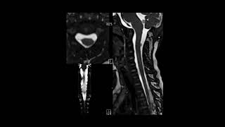 Intradural extramedullary schwannoma of the cervical spine [upl. by Asen]