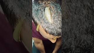 Leech Therapy for hair regrowth viralvideo hair alternativemedicine shortsfeed [upl. by Padraic294]