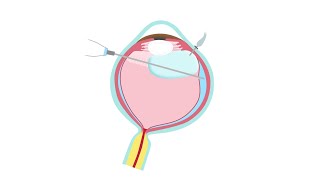 Retinal Detachment Treatment—Pars Plana Vitrectomy [upl. by Airdnaid]