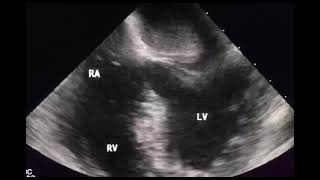 Myxoma of left atrium to drahmadmirdamadisioADLyE2hgoFzsvK [upl. by Asoj591]