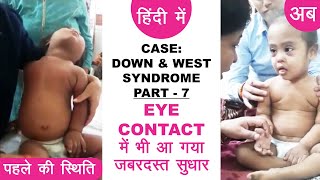 Down Syndrome amp West Syndrome Case  Part 7  EYE CONTACT में भी आ गया जबरदस्त सुधार  हिंदी मे [upl. by Dessma106]