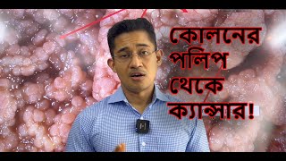 কোলনের পলিপ থেকে ক্যান্সার [upl. by Yeltrab]