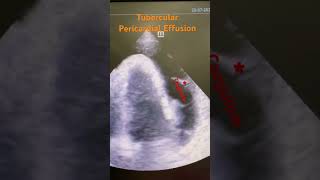 Tubercular pericardial effusion echo radiology tb cardiology [upl. by Ashly]