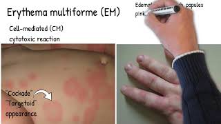 Erythema Multiform  Simply explained skin redness and rush pinkred ring around a pale center [upl. by Lenahtan999]