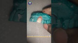 Upper Removable Partial Denture  Single Unit 22  URPD  Tamil Dental Lab  dentalcare viralvideo [upl. by Savell]